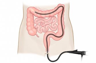 Как подготовиться к колоноскопии